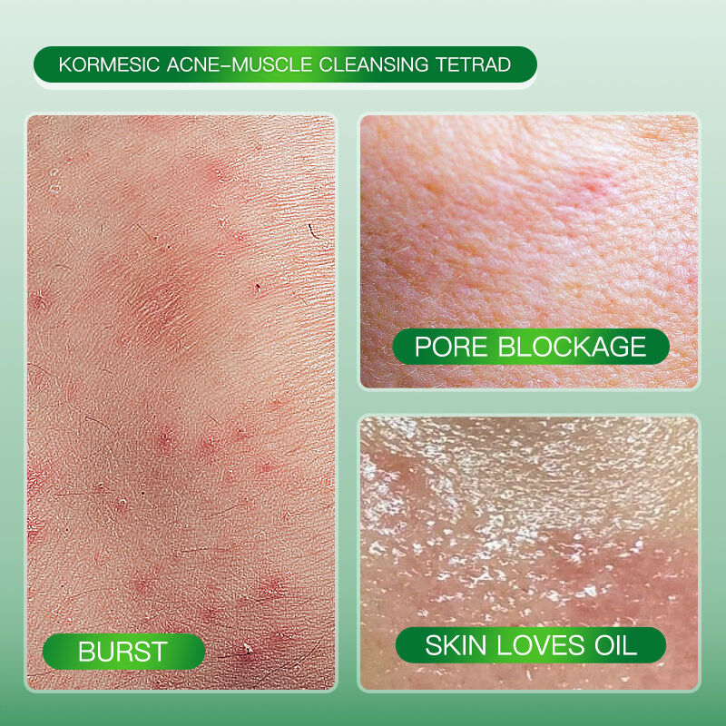 Nettoyant Visage Anti-acné – Contrôle Du Sébum & Réduction Des Boutons