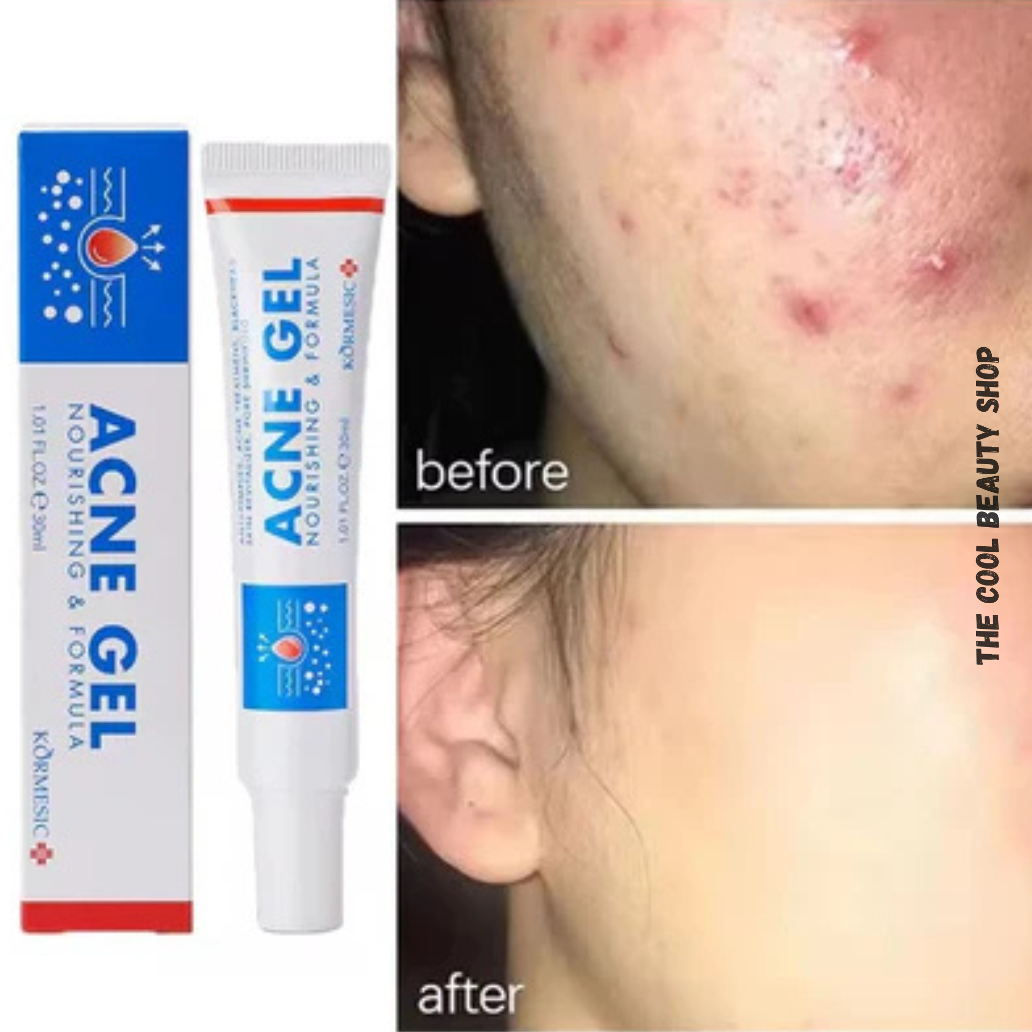 Anti-acné Visage, Gel Anti-acné, Formule Nourrissante thumbnail 4