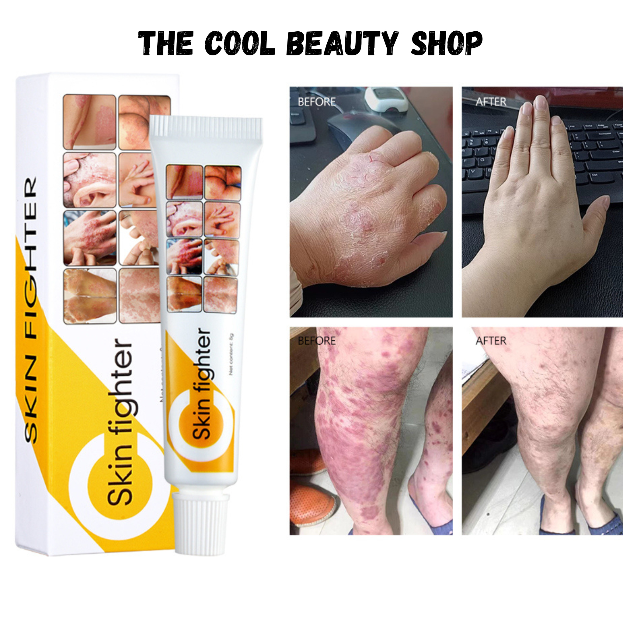 Crème Anti-démangeaisons & Anti-irritations – Eczéma, Rougeurs Et Mycoses