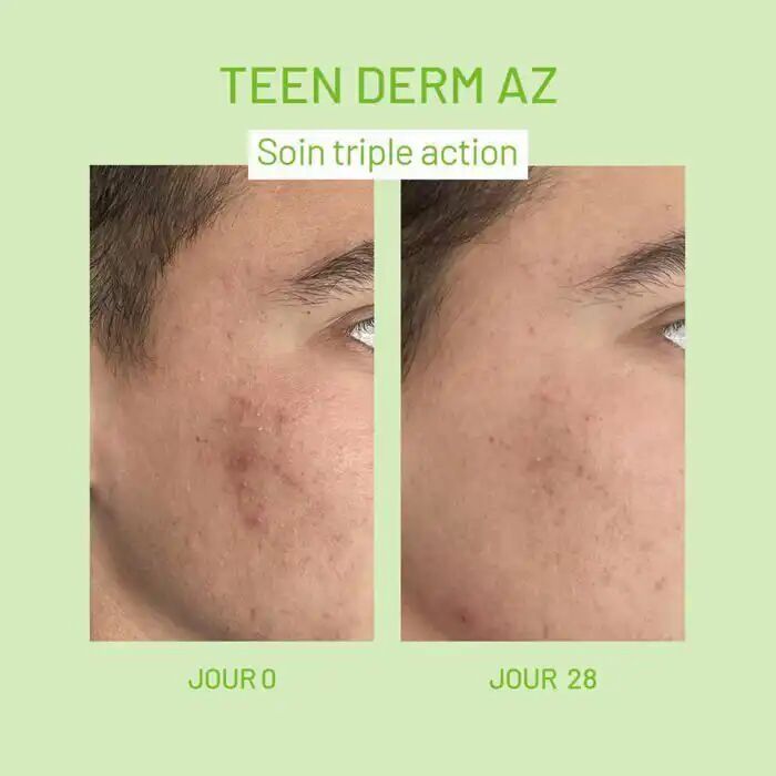 Crème Teen Derm A.Z Acide Azélaïque 15% Peaux Grasses Non Comédogène thumbnail 4